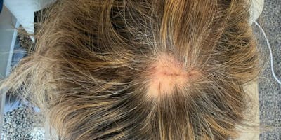 Hair Restoration Before & After Gallery - Patient 295925 - Image 1