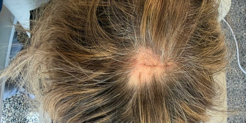 Hair Restoration Before & After Gallery - Patient 295925 - Image 1