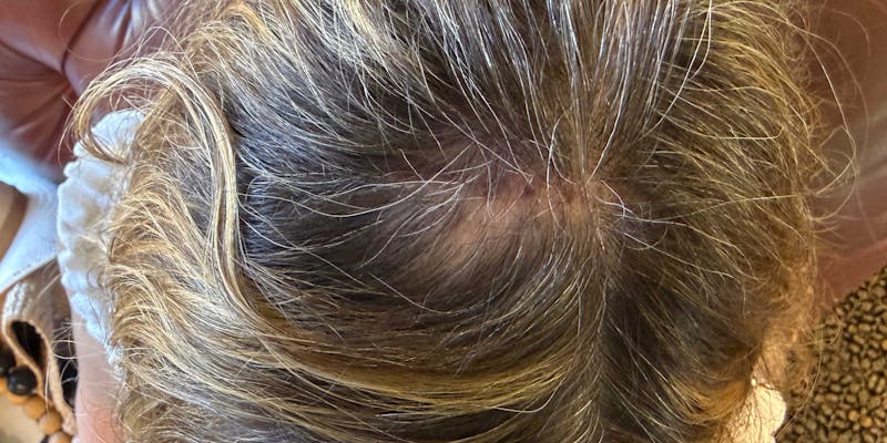 Hair Restoration Before & After Gallery - Patient 295925 - Image 2