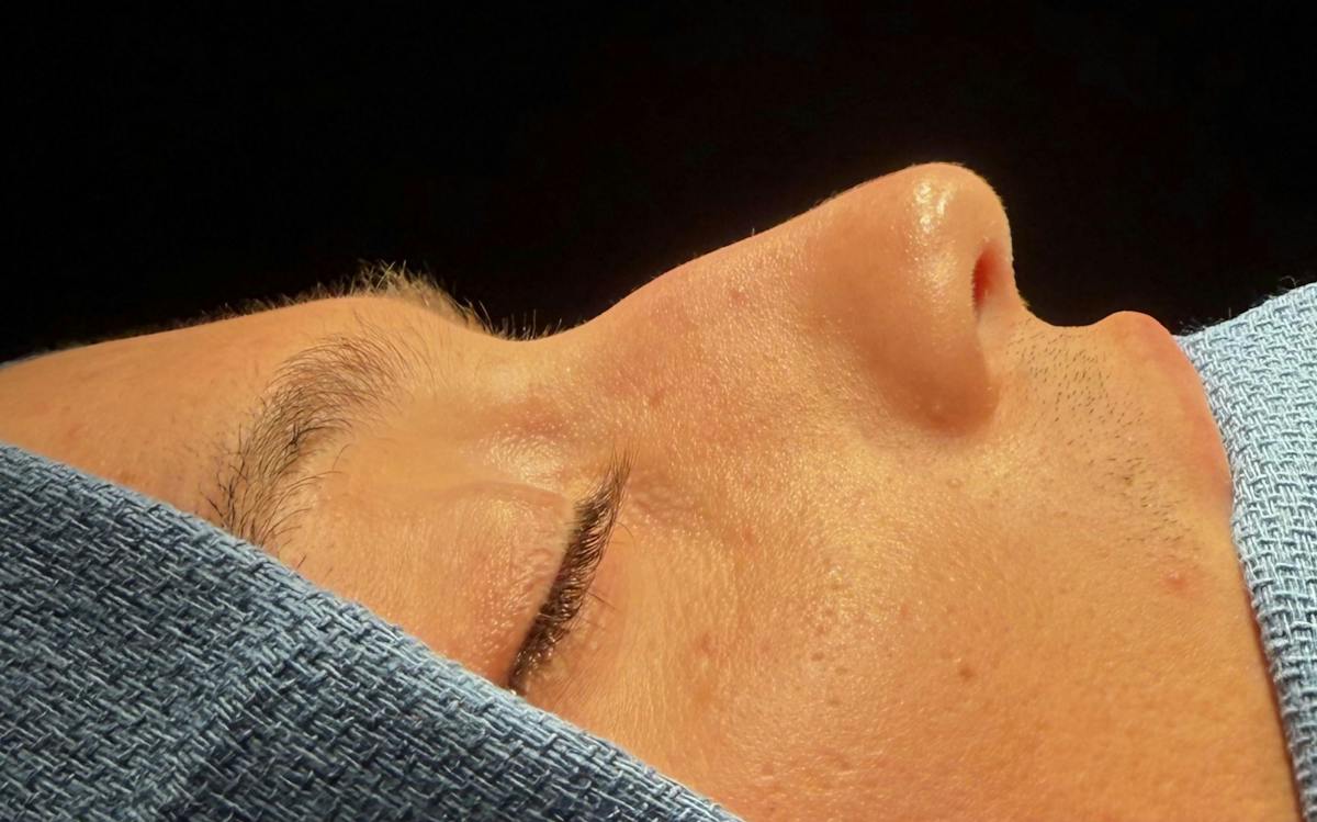 Rhinoplasty Before & After Gallery - Patient 302461 - Image 1