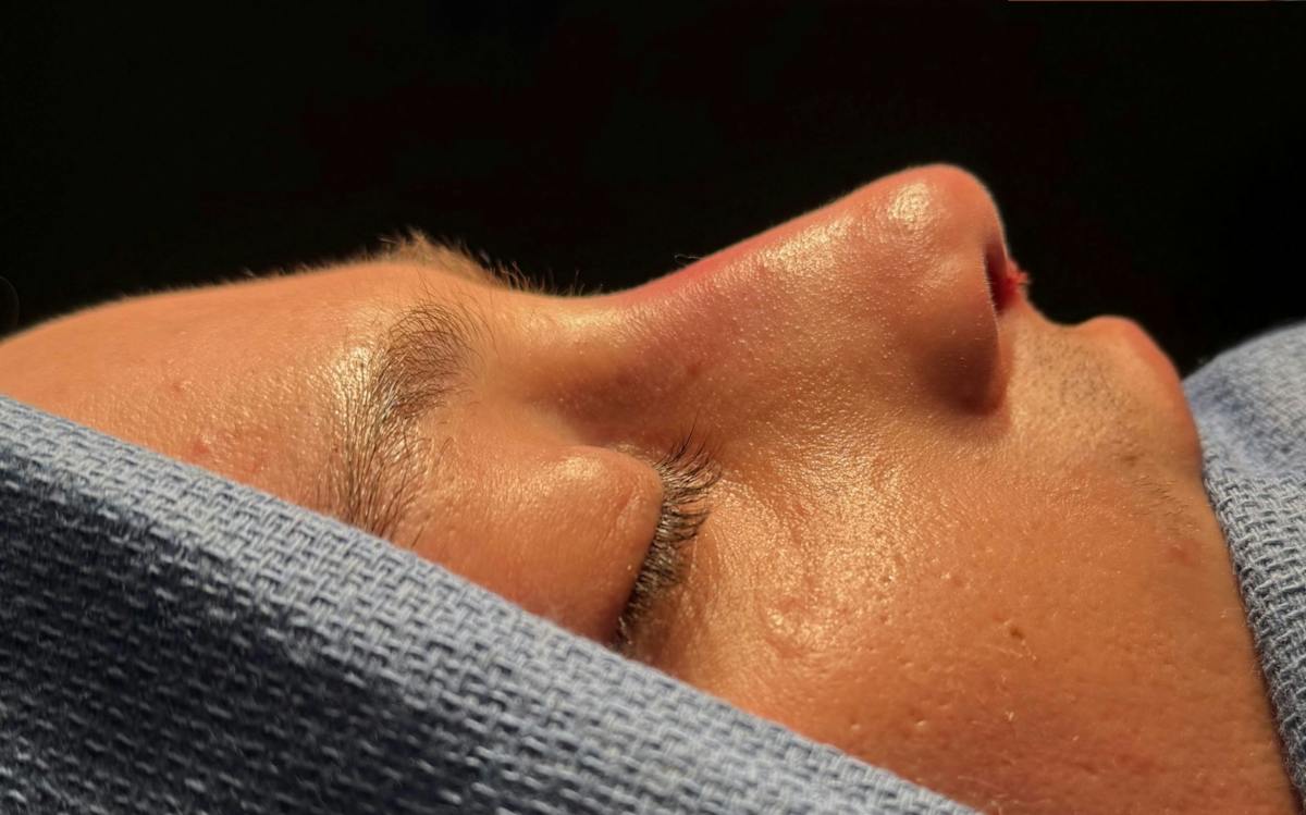 Rhinoplasty Before & After Gallery - Patient 302461 - Image 2