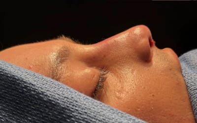 Revision Rhinoplasty Before & After Gallery - Patient 256518 - Image 2