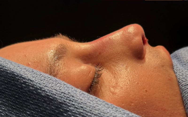 Rhinoplasty Before & After Gallery - Patient 302461 - Image 2