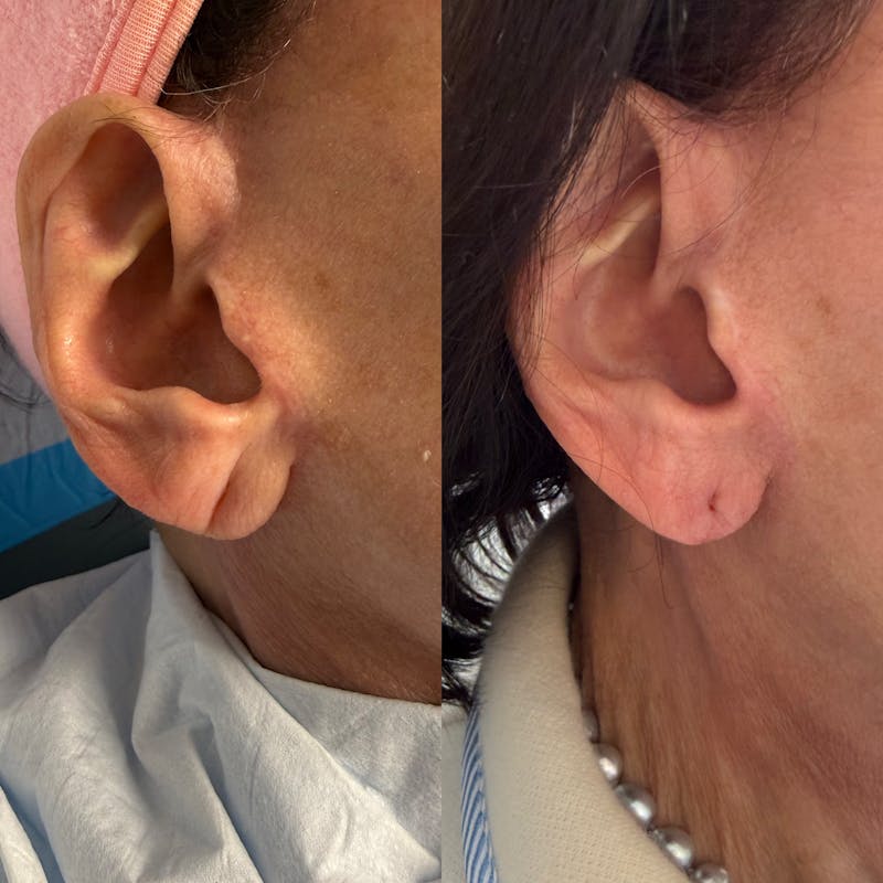 Earlobe Repair Before & After Gallery - Patient 397473 - Image 1