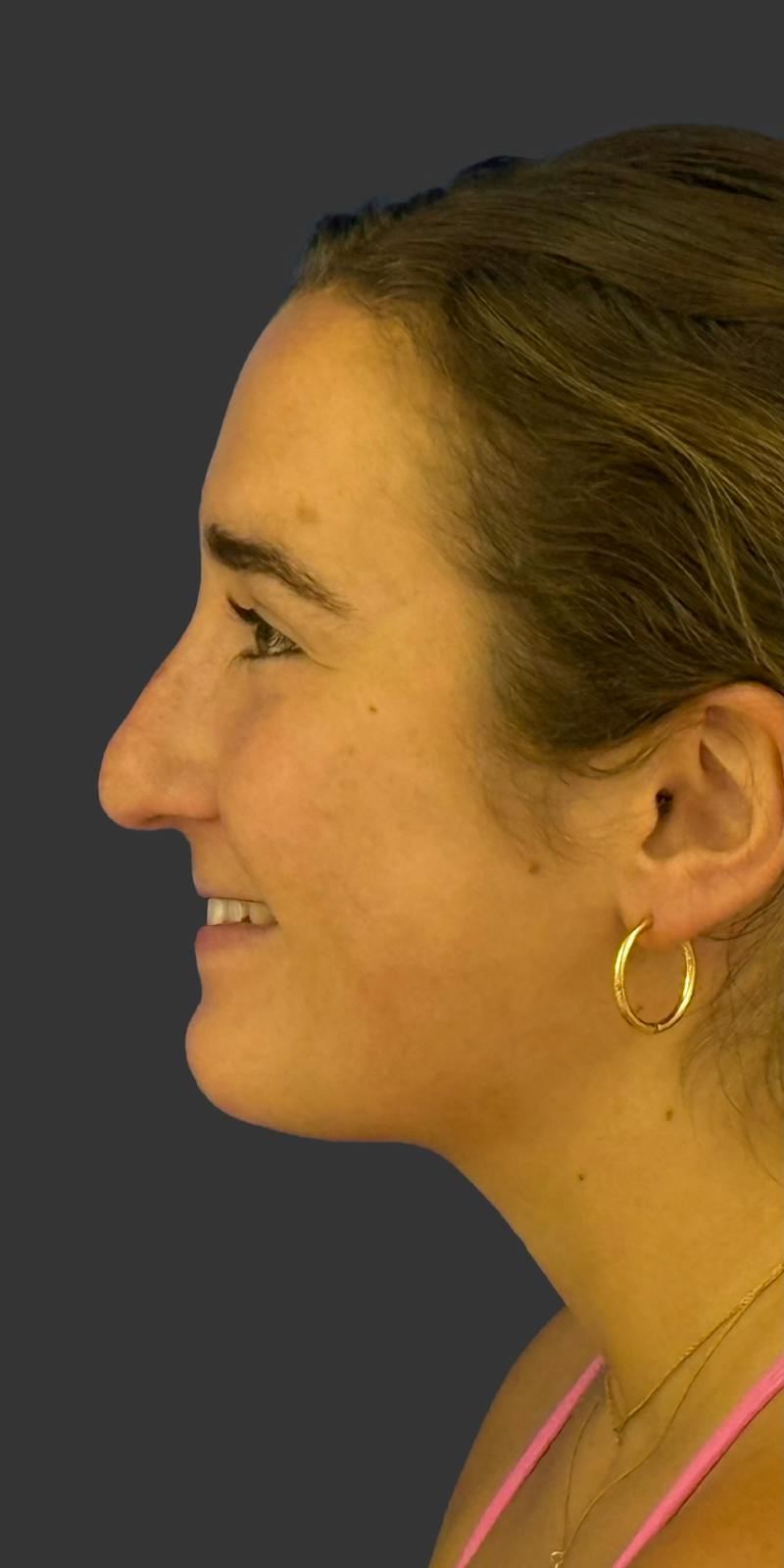 Rhinoplasty Before & After Gallery - Patient 169813 - Image 1