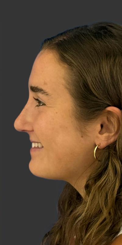 Rhinoplasty Before & After Gallery - Patient 169813 - Image 2