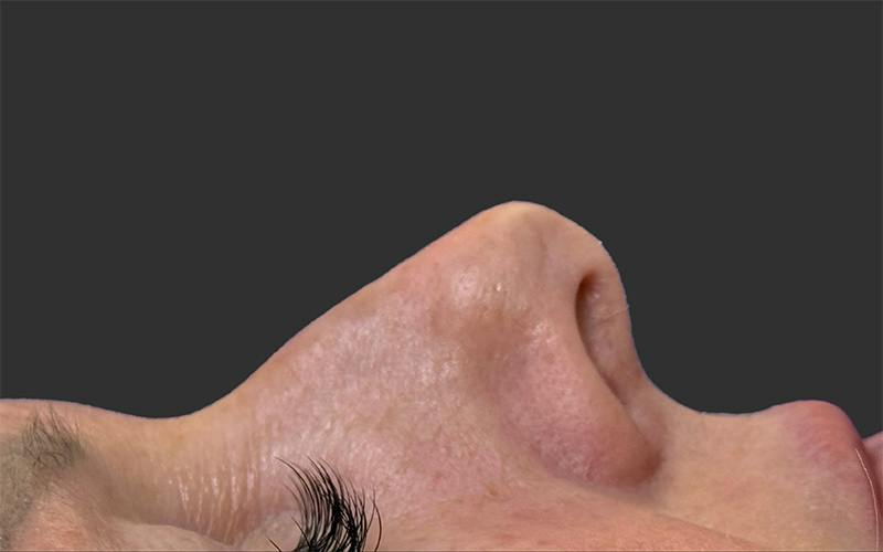 Rhinoplasty Before & After Gallery - Patient 342865 - Image 1