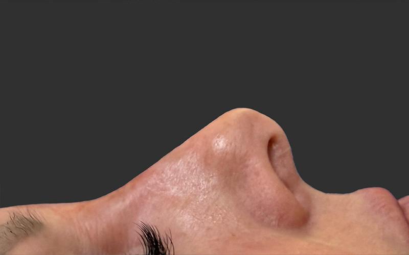 Rhinoplasty Before & After Gallery - Patient 342865 - Image 2