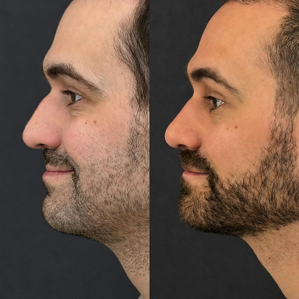 Rhinoplasty Before & After Gallery - Patient 424103 - Image 1