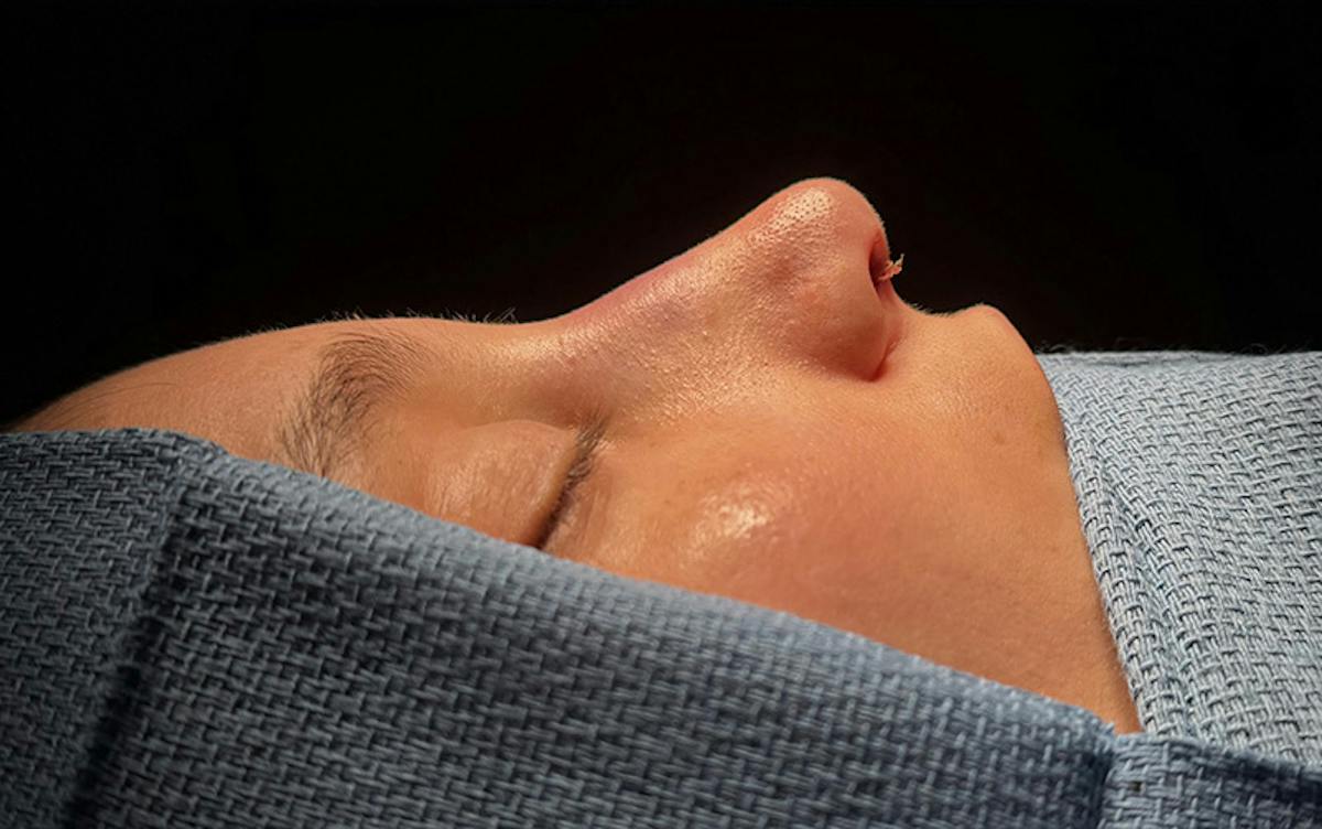 Rhinoplasty Before & After Gallery - Patient 171202 - Image 2