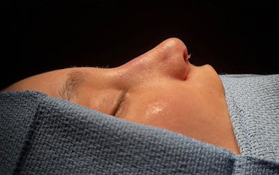Rhinoplasty Before & After Gallery - Patient 171202 - Image 2
