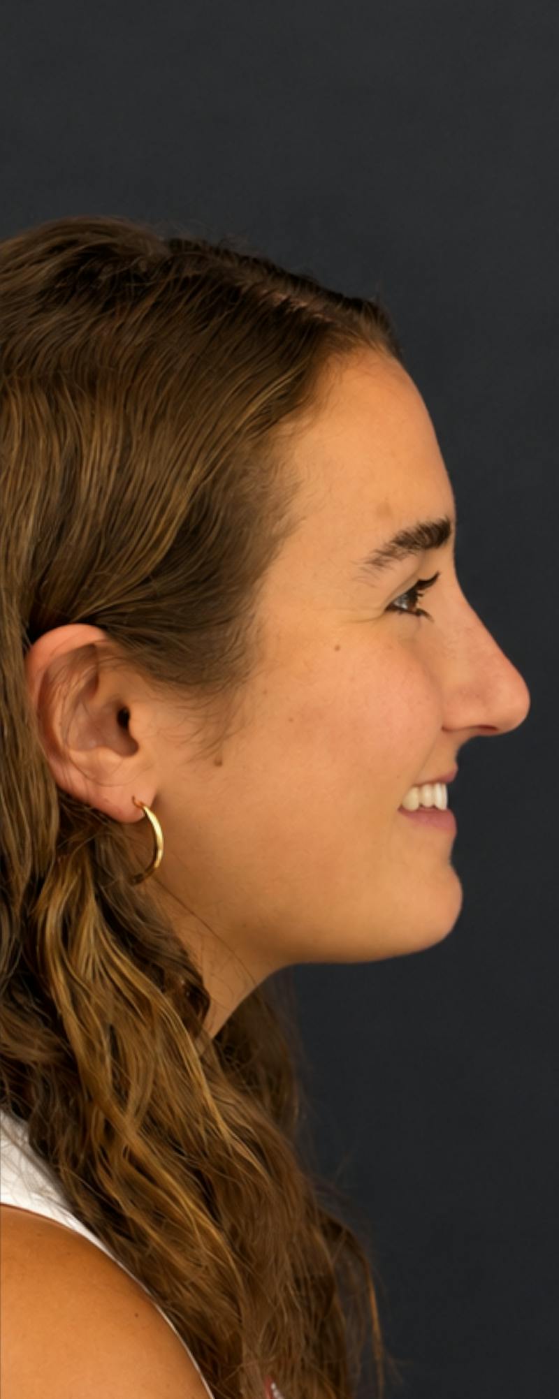 Rhinoplasty Before & After Gallery - Patient 169813 - Image 4