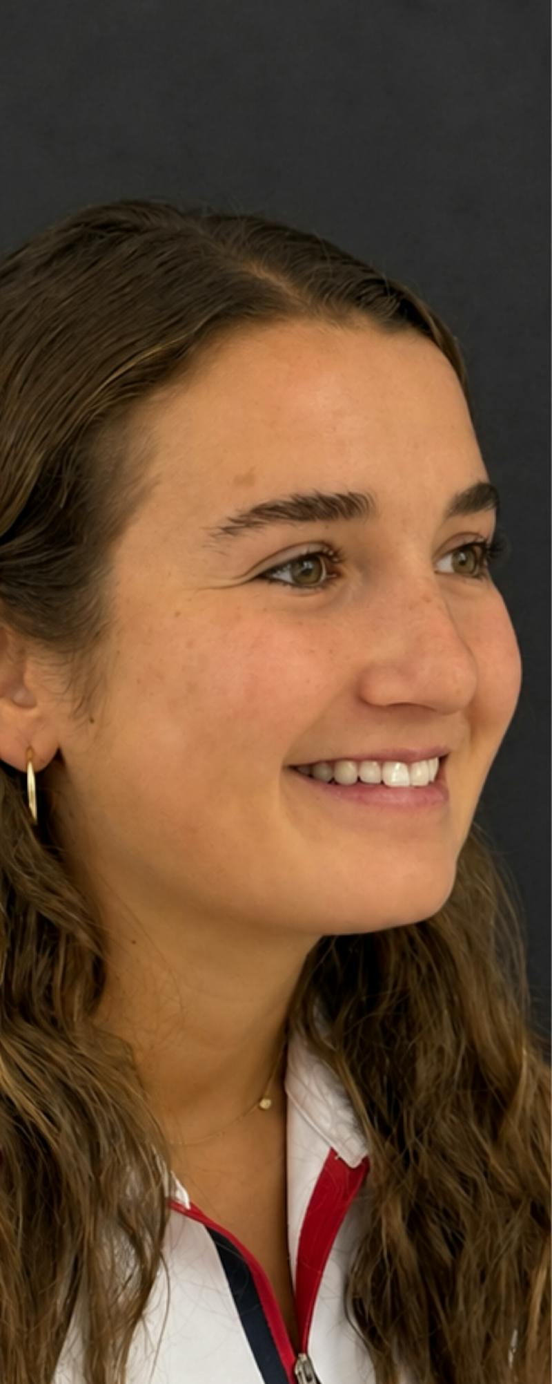 Rhinoplasty Before & After Gallery - Patient 169813 - Image 6