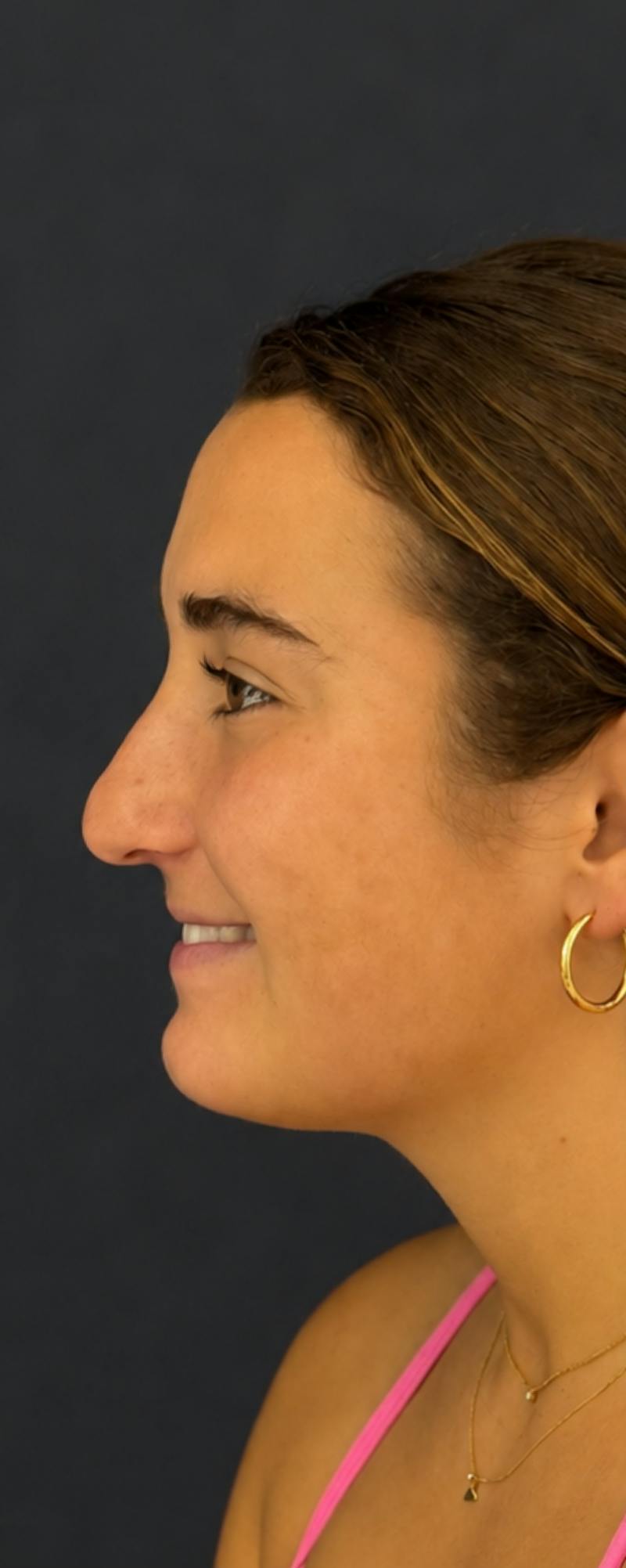 Rhinoplasty Before & After Gallery - Patient 169813 - Image 1