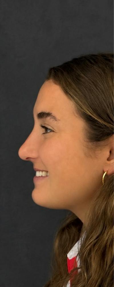 Rhinoplasty Before & After Gallery - Patient 169813 - Image 2