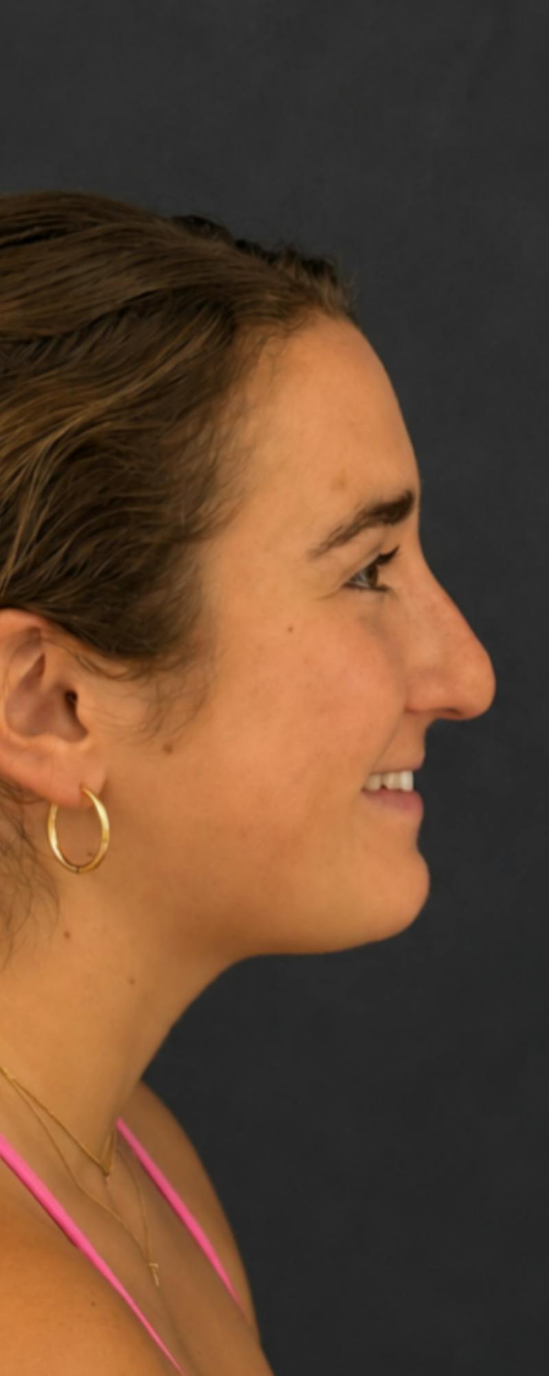Rhinoplasty Before & After Gallery - Patient 169813 - Image 3
