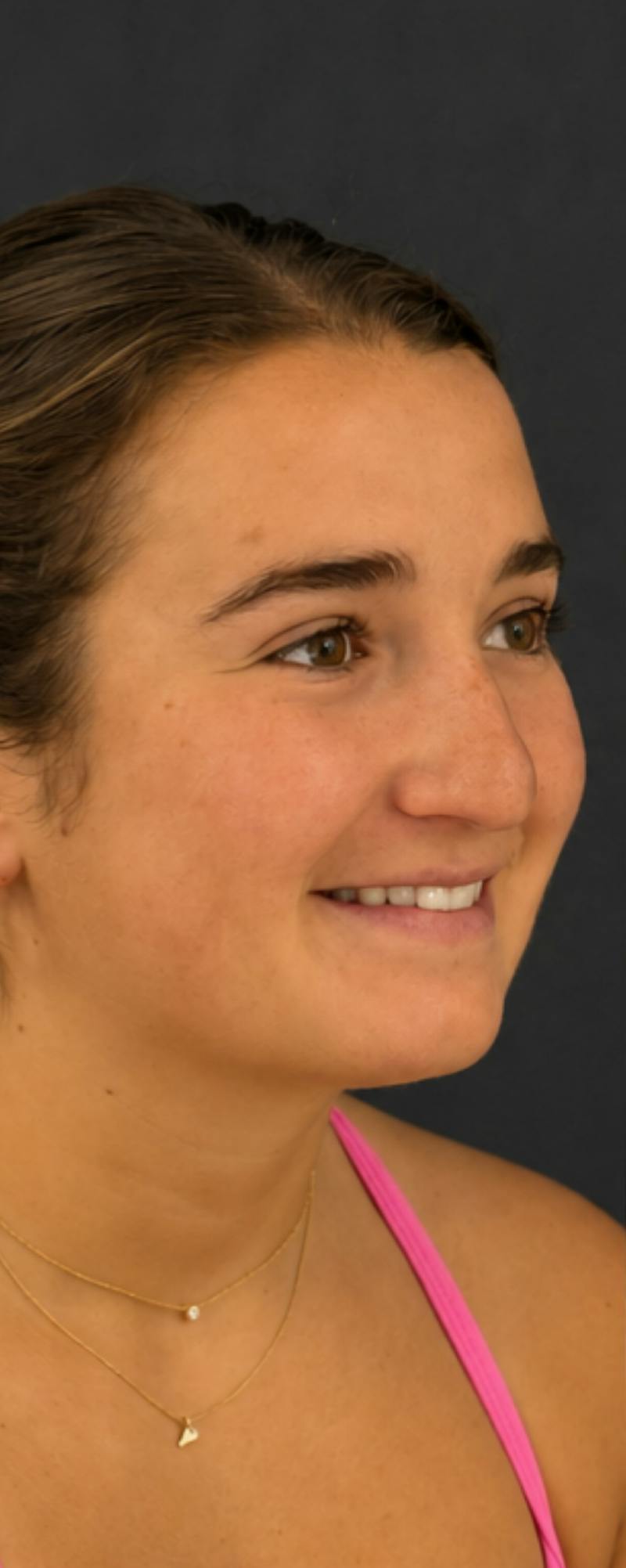 Rhinoplasty Before & After Gallery - Patient 169813 - Image 5