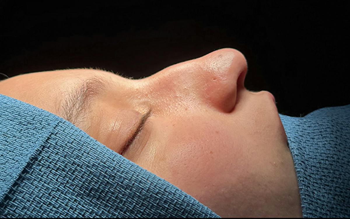 Rhinoplasty Before & After Gallery - Patient 171202 - Image 1