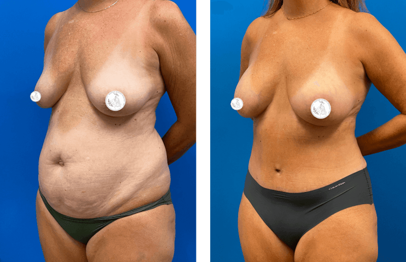 Abdominoplasty Before & After Gallery - Patient 412118 - Image 1