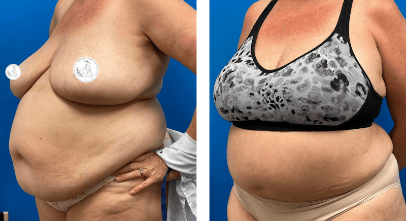 Abdominoplasty Before & After Gallery - Patient 126517 - Image 1