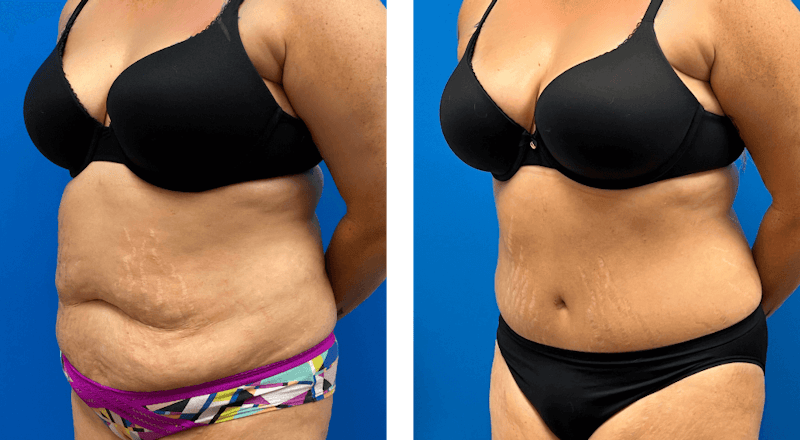 Abdominoplasty Before & After Gallery - Patient 680721 - Image 1