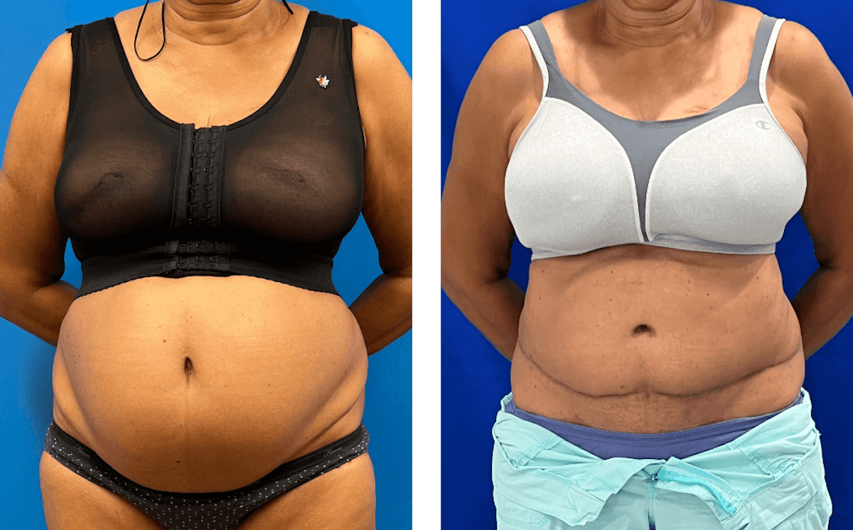 Abdominoplasty Before & After Gallery - Patient 347091 - Image 1