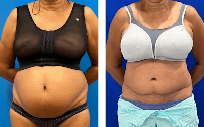 Abdominoplasty Before & After Gallery - Patient 347091 - Image 1