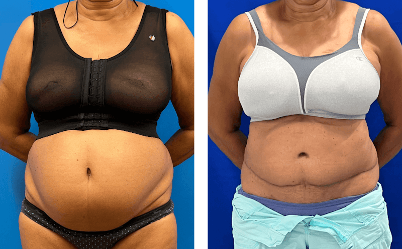 Abdominoplasty Before & After Gallery - Patient 347091 - Image 1
