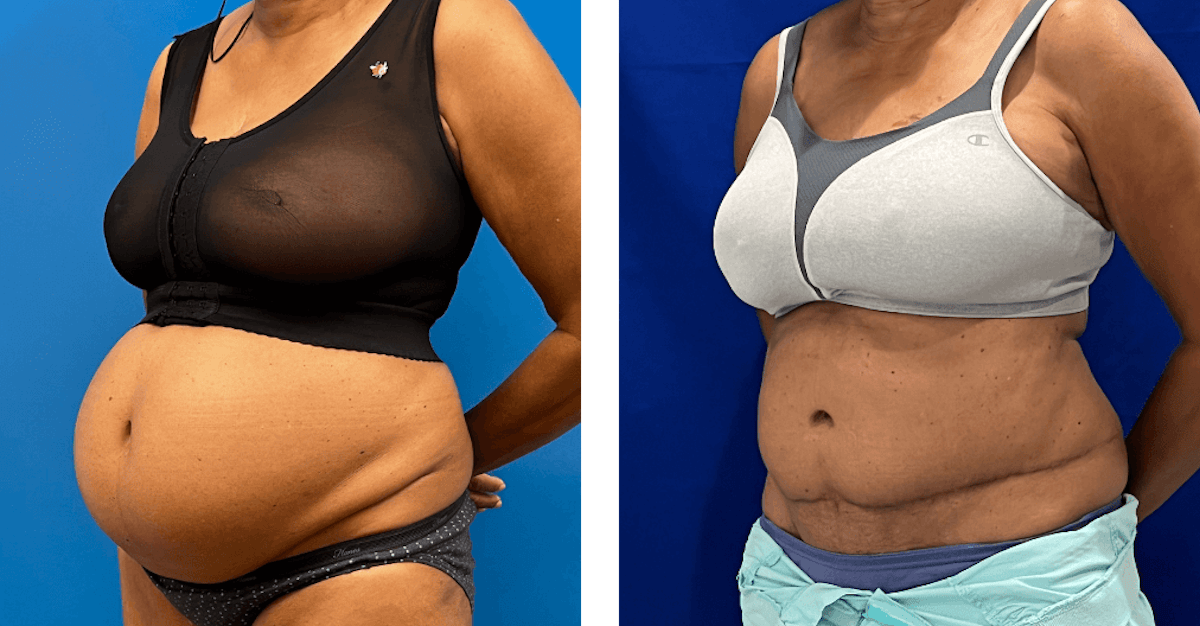 Abdominoplasty Before & After Gallery - Patient 347091 - Image 2