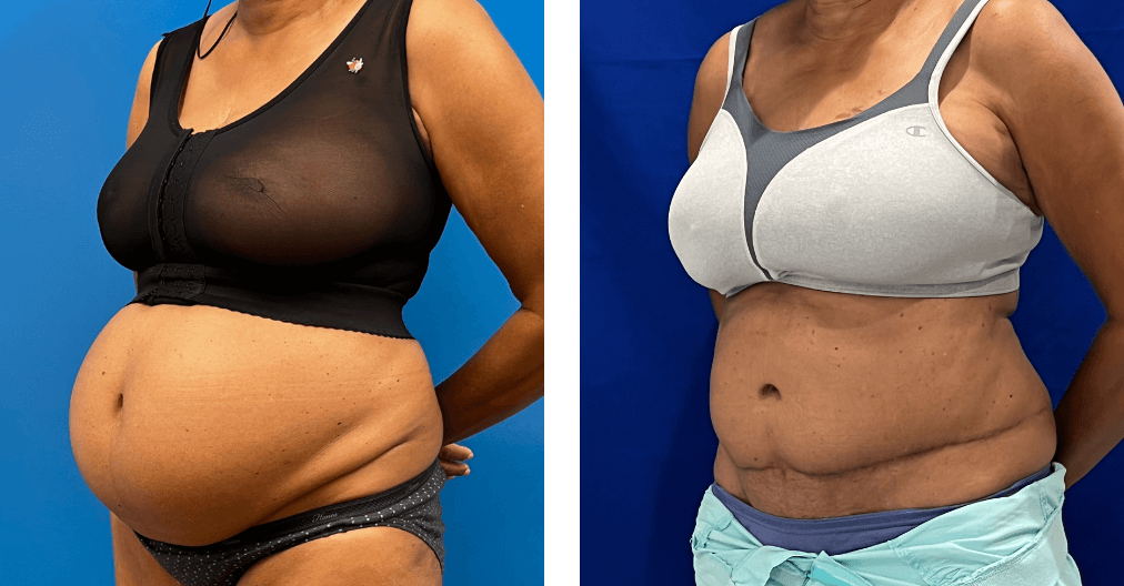 Abdominoplasty Before & After Gallery - Patient 347091 - Image 2