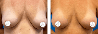 Breast Augmentation Before & After Gallery - Patient 416703 - Image 1