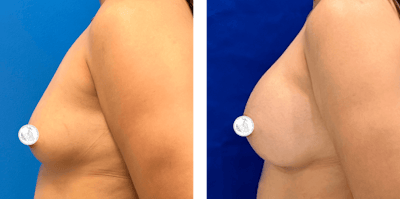 Breast Augmentation Before & After Gallery - Patient 907468 - Image 1