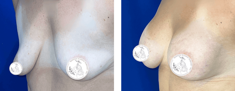 Breast Augmentation Before & After Gallery - Patient 236736 - Image 1