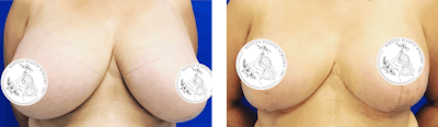 Breast Reduction Before & After Gallery - Patient 269787 - Image 1