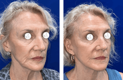 Face Lift Before & After Gallery - Patient 306856 - Image 1