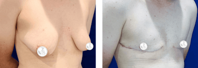 FTM Gender Confirmation Surgery Before & After Gallery - Patient 231587 - Image 1