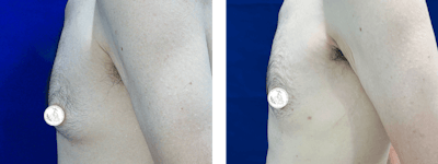 Gynecomastia Before & After Gallery - Patient 168026 - Image 1