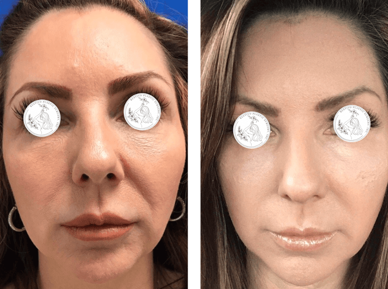 Laser Resurfacing Before & After Gallery - Patient 359257 - Image 1