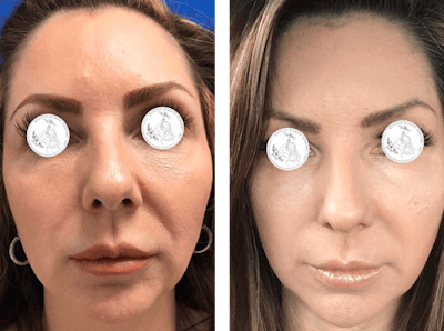 Laser Resurfacing Before & After Gallery - Patient 359257 - Image 1