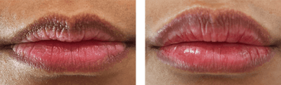 Lip Filler Before & After Gallery - Patient 999427 - Image 1