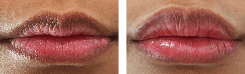Lip Filler Before & After Gallery - Patient 999427 - Image 1