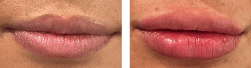 Lip Filler Before & After Gallery - Patient 100083 - Image 1
