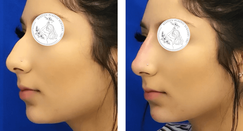 Non-Surgical Rhinoplasty Before & After Gallery - Patient 677346 - Image 1
