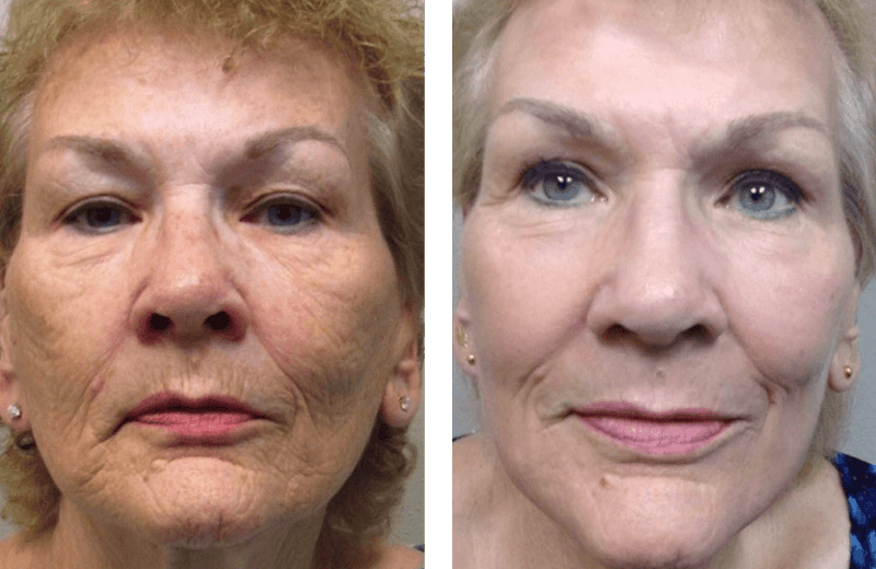 Renuvion Resurfacing Before & After Gallery - Patient 375047 - Image 1