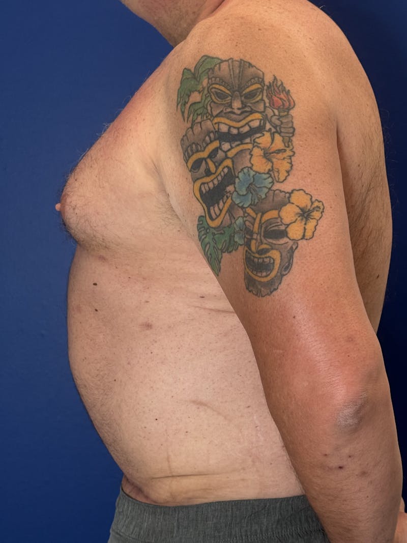 Abdominoplasty Before & After Gallery - Patient 383053 - Image 6