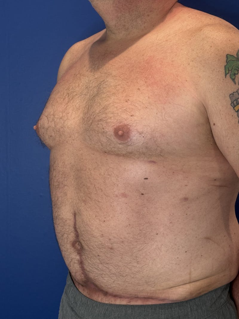 Abdominoplasty Before & After Gallery - Patient 383053 - Image 8