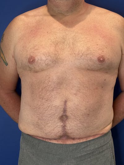 Abdominoplasty Before & After Gallery - Patient 383053 - Image 2