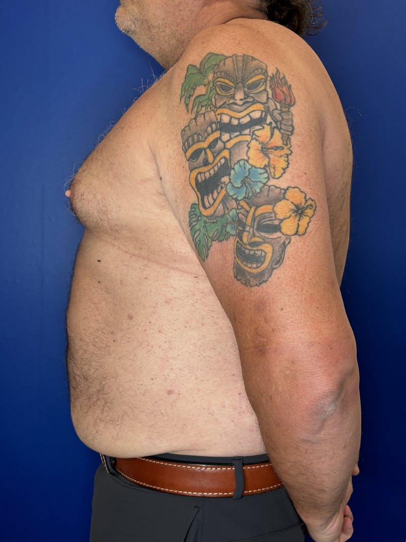 Abdominoplasty Before & After Gallery - Patient 383053 - Image 5