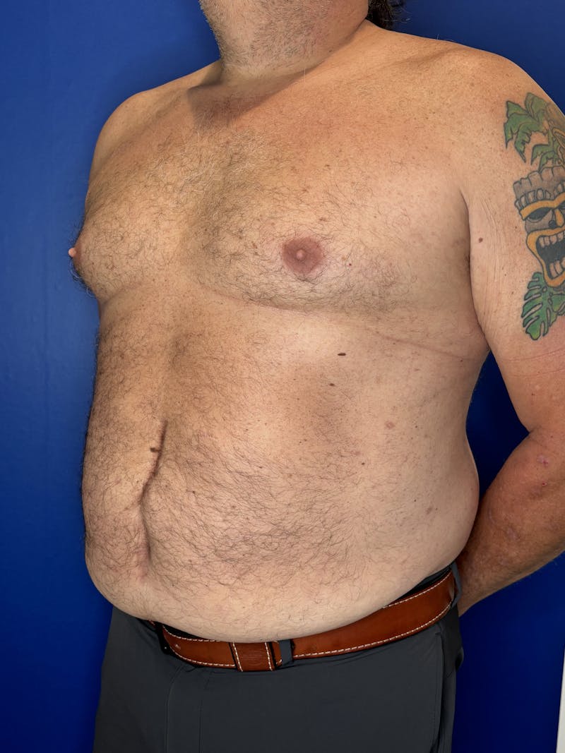 Abdominoplasty Before & After Gallery - Patient 383053 - Image 7