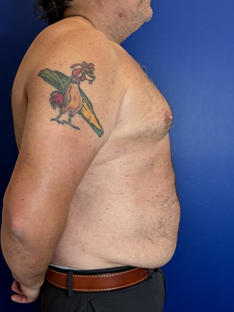 Abdominoplasty Before & After Gallery - Patient 383053 - Image 9
